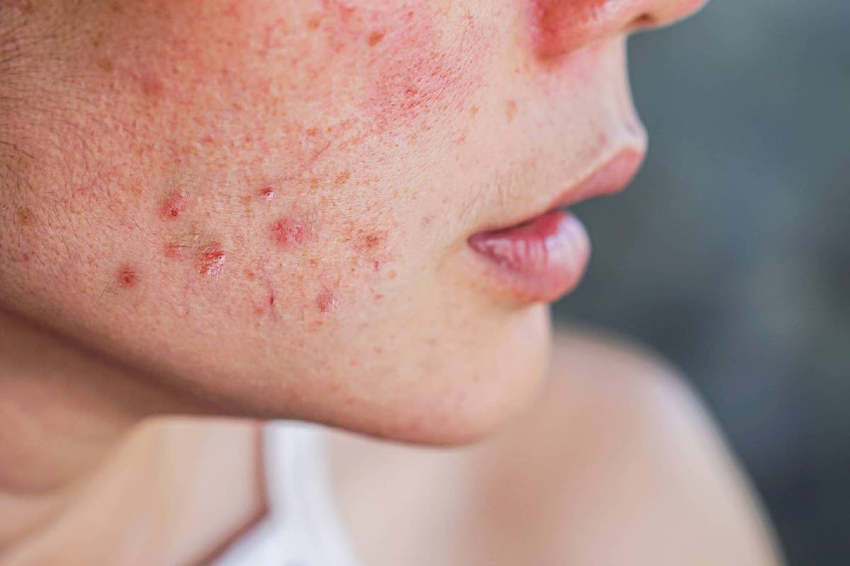 menopausal acne